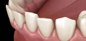 Αραιοδοντία Spacing