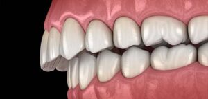 Βαθειά Δήξη Deep Bite