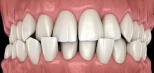 Σταυροειδής Σύγκλειση Crossbite