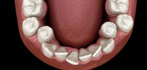 Συνωστισμός Crowding