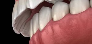 Τάξη Δεύτερη Class II malocclusion