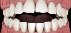 Χασμοδόντια Open Bite